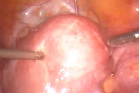 자궁근종의 복강경을 이용한 근종 절제술 (수술 전)