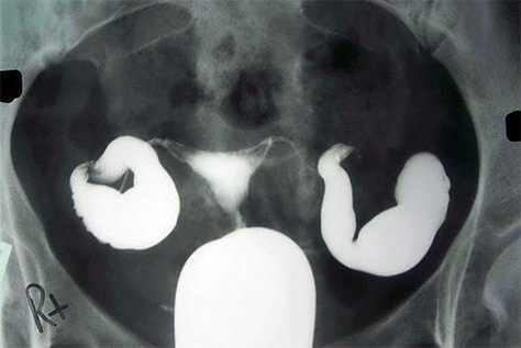 난관 수종의 자궁난관조영술 사진
